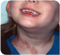7-year-old girl with a large PN on her neck.