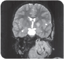 X-ray image of a 7-year-old girl with a large PN on her neck.
