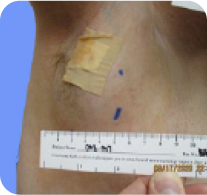 40-year-old male with head/neck PN at baseline in ReNeu case study.