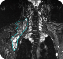 X-ray image of a 40-year-old male with head/neck PN at baseline in ReNeu case study.