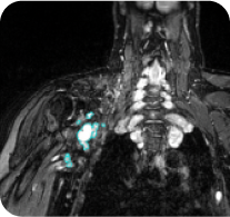 X-ray image of a 40-year-old male with a head/neck PN at cycle 36 in ReNeu case study