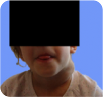 7-year-old female with neck PN at baseline
