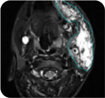 X-ray image of an 8-year-old male with head/neck PN at baseline