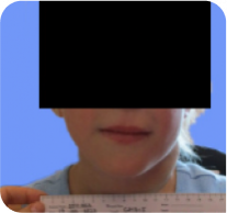 7-year-old female with neck PN at cycle 21 of ReNeu study
