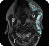 X-ray image of an 8-year-old male with head/neck PN at cycle 24 of the ReNeu study